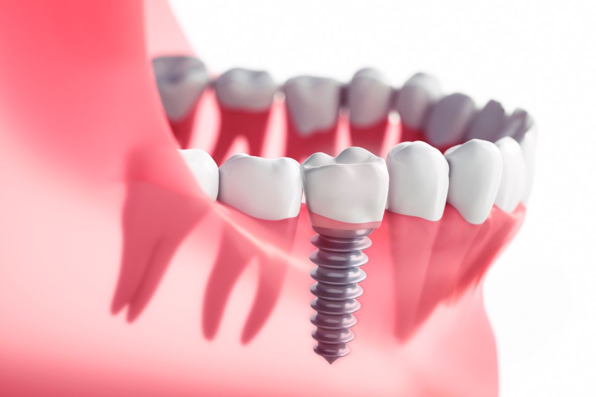 Imagen 3D de un implante dental - Clínica Mayor 4